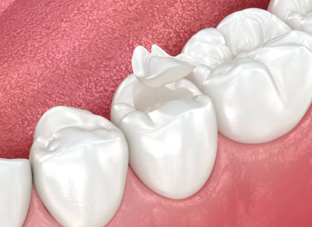 Best Dental Fillings (Composite and Amalgam)  in Long Beach, CA